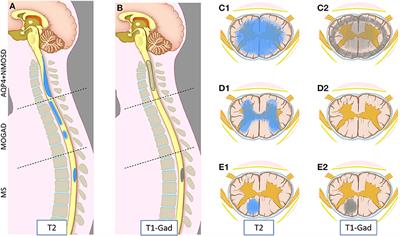 Myelitis features and outcomes in CNS demyelinating disorders: Comparison between multiple sclerosis, MOGAD, and AQP4-IgG-positive NMOSD